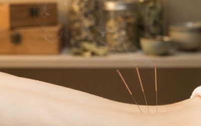 Doet acupunctuur pijn?