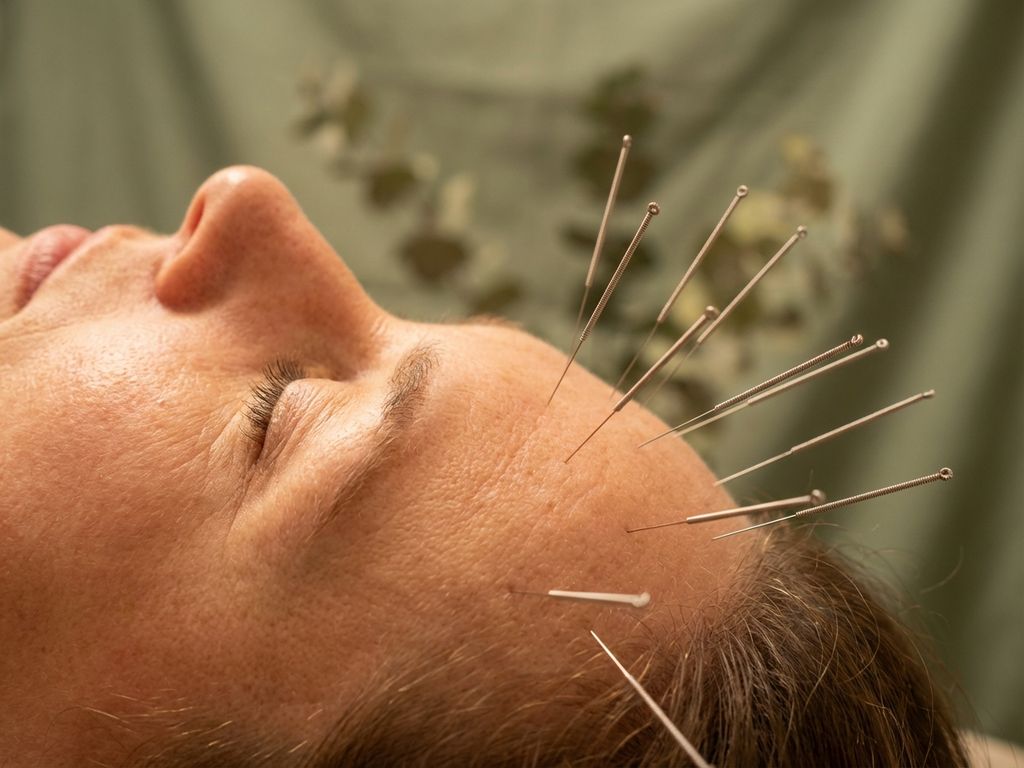 acupunctuur-naalden-hoofd-behandeling-therapie.jpg Acupunctuurnaalden precies geplaatst op hoofdmeridiaanpunten tijdens professionele behandeling