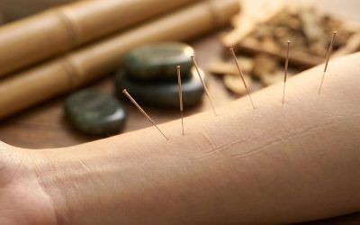 Helpt cosmetische acupunctuur tegen rimpels?