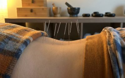 Is acupunctuur effectief voor rugpijn?